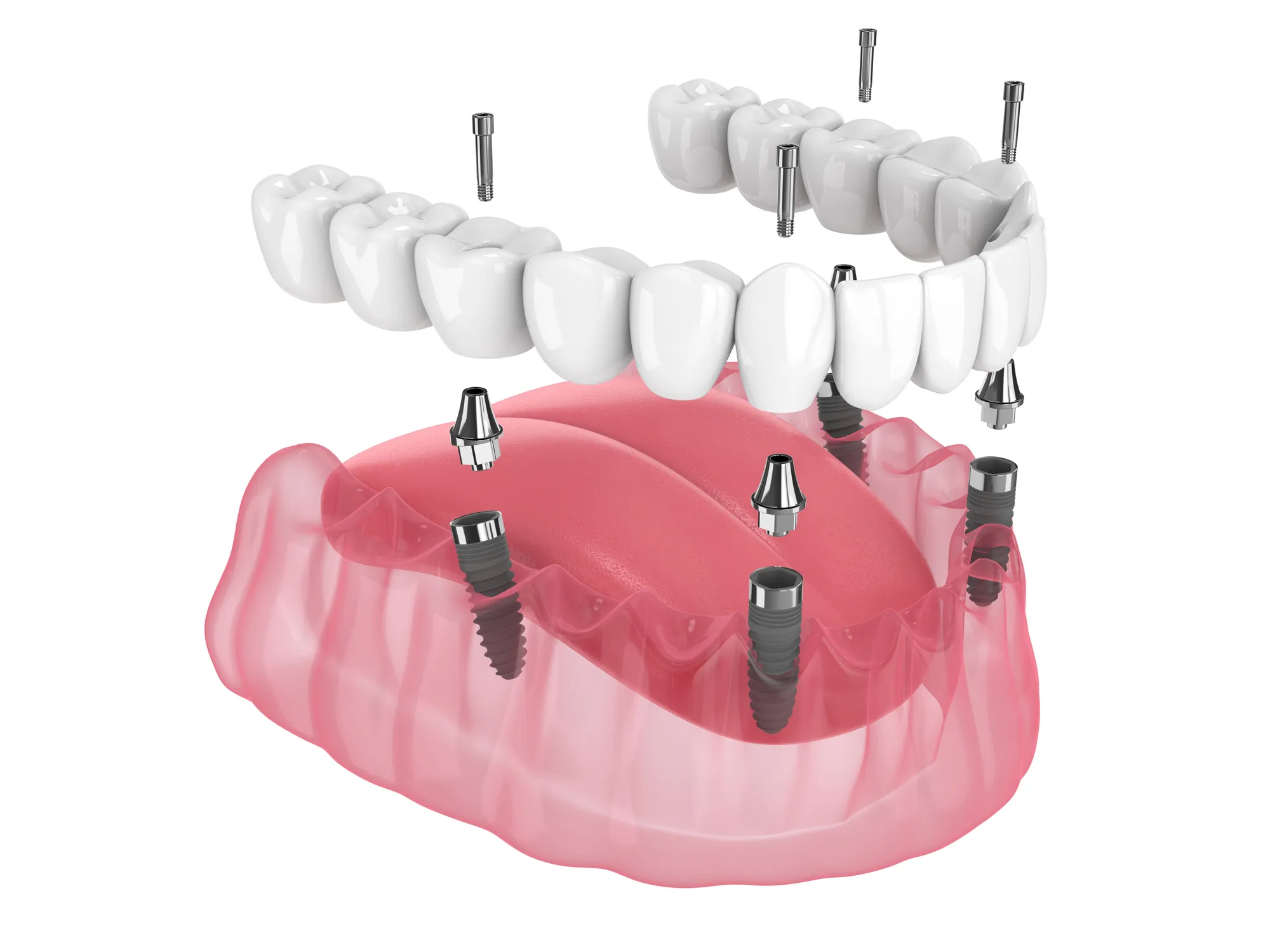 Upper Dental implant treatment room in Hollywood, FL