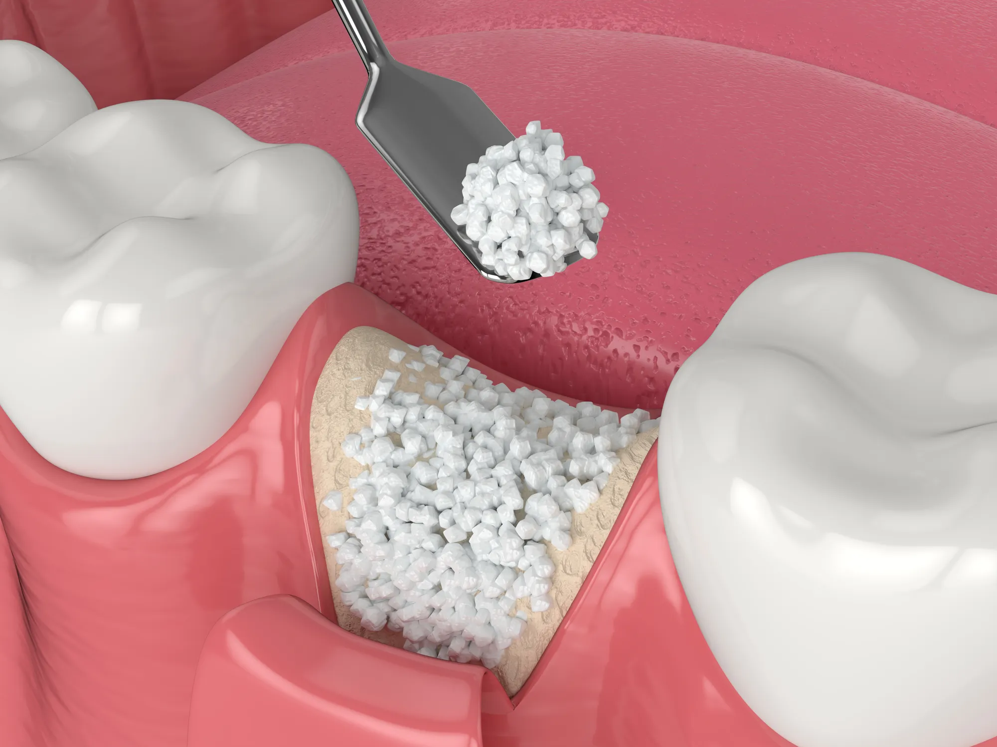 Upper Dental implant treatment room in Hollywood, FL
