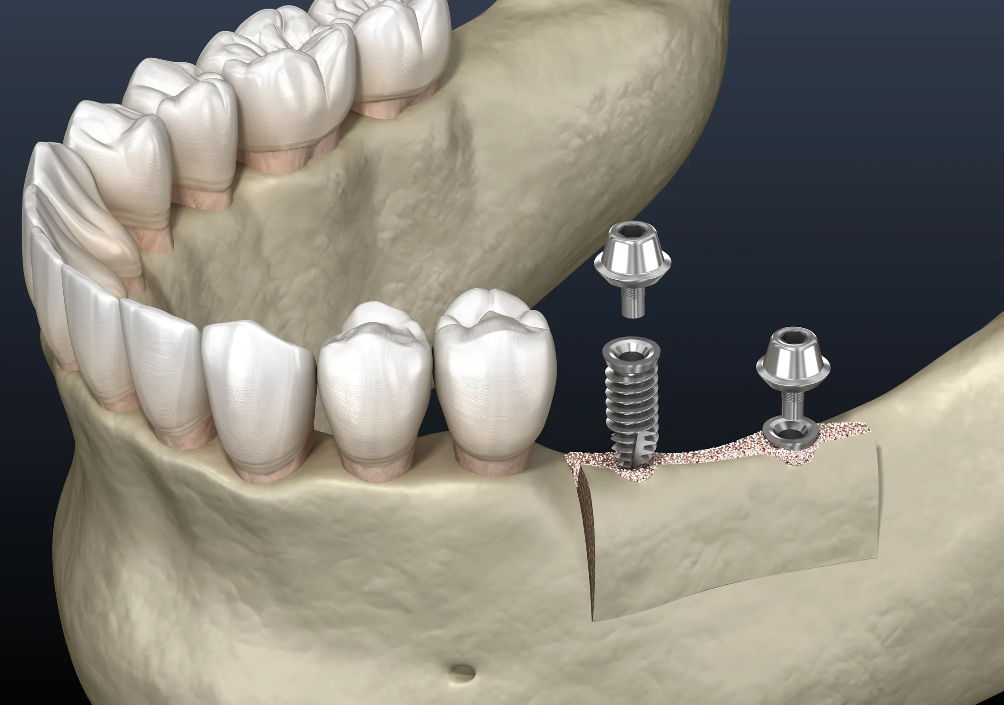 Upper Dental implant treatment room in Hollywood, FL